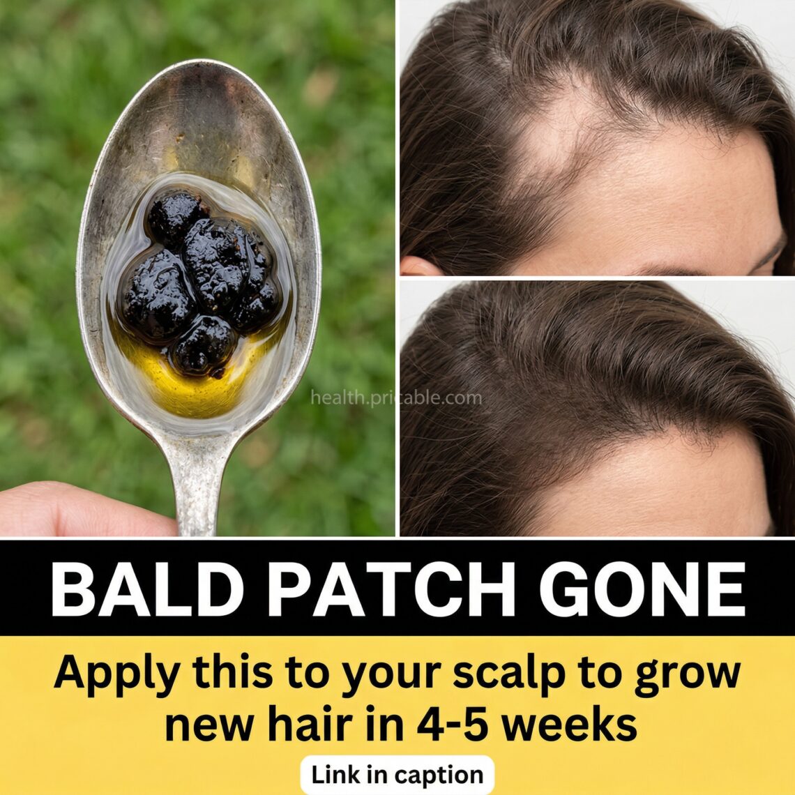 clove oil for bald patch