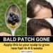 clove oil for bald patch