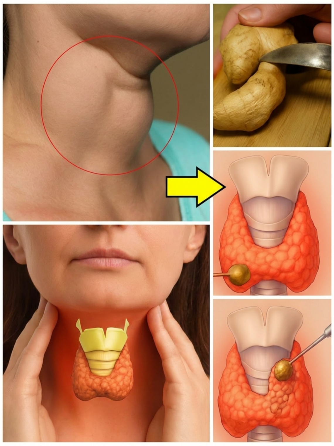 Ginger for Thyroid Swelling? What This Traditional Remedy Can and Cannot Do