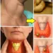 Ginger for Thyroid Swelling? What This Traditional Remedy Can and Cannot Do