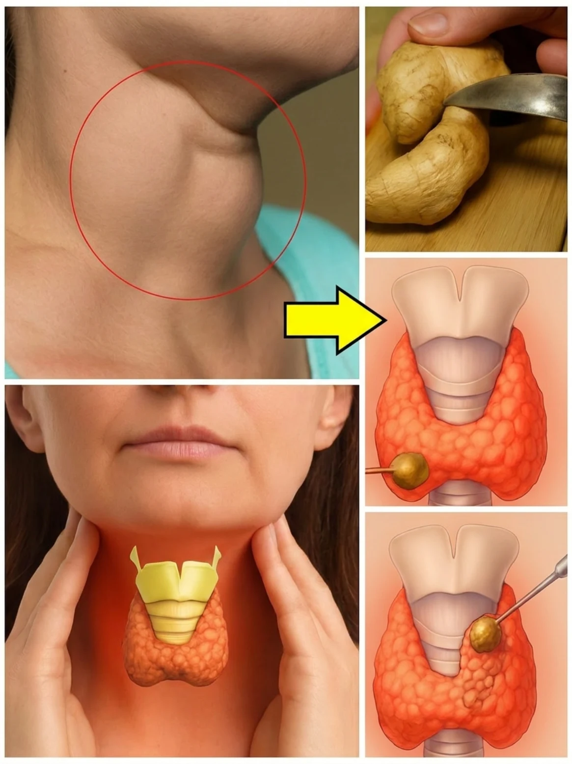 Ginger for Thyroid Swelling? What This Traditional Remedy Can and Cannot Do