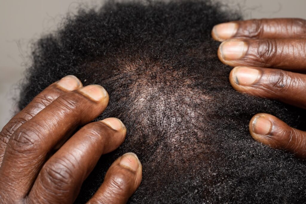 A woman gently massaging oil into her scalp with her fingertips focusing on the roots Her hair is parted showing a clear