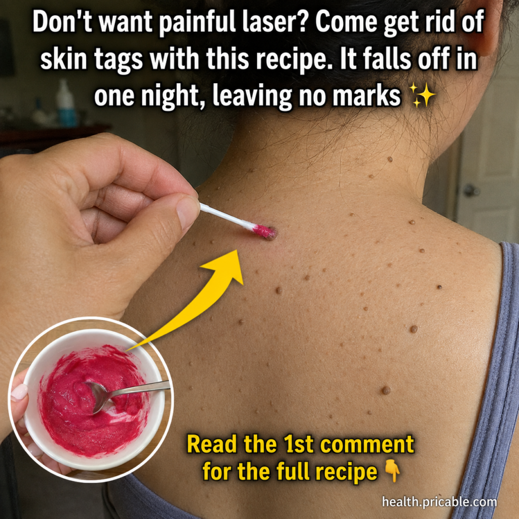 A hand applying a pinkish-red paste with a cotton swab to a small skin tag on a person s back with a small bowl of the p
