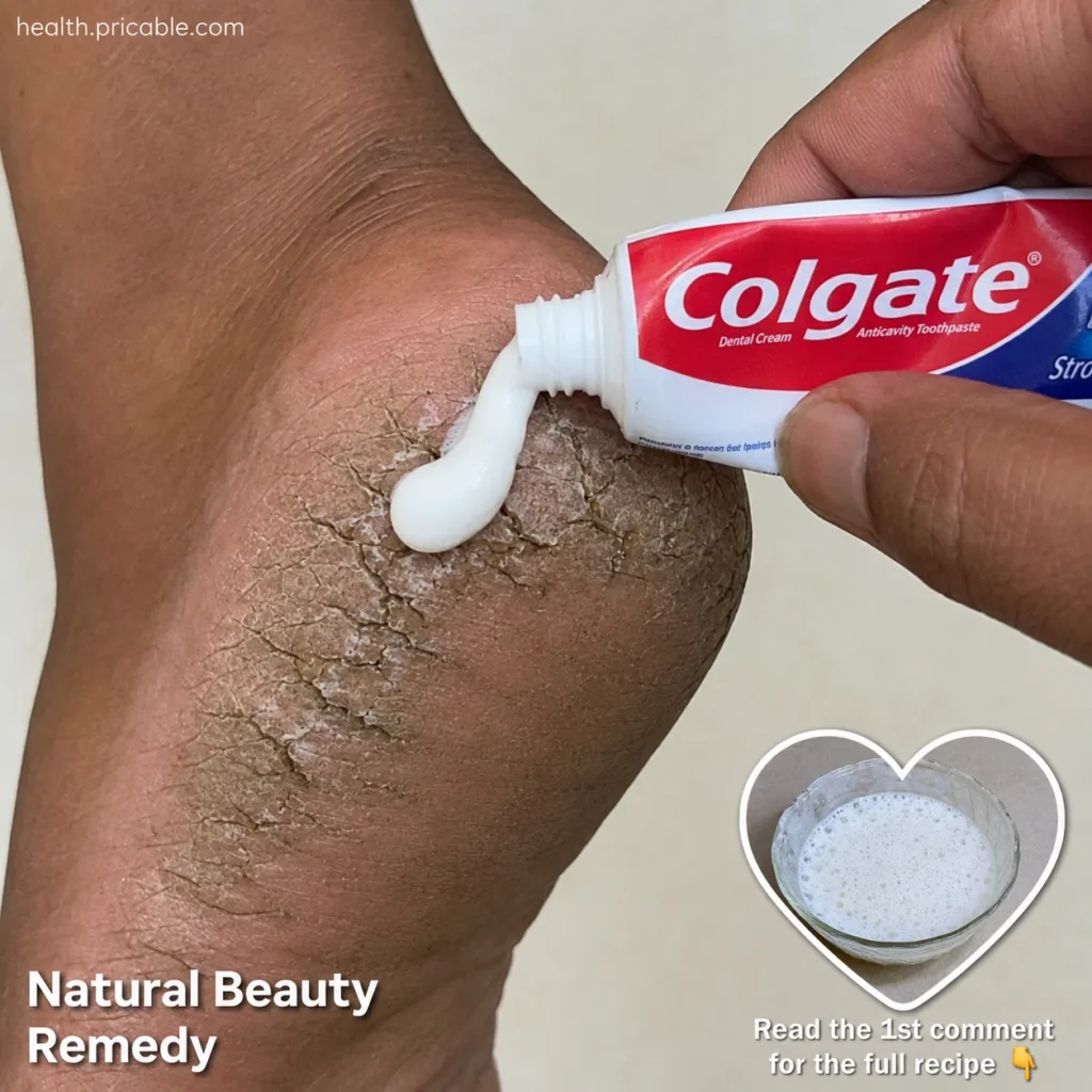 A tube of white toothpaste possibly Colgate next to a pair of feet with dry cracked heels illustrating the viral hack