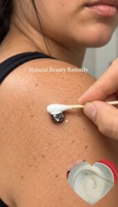 A close-up of a small skin tag on a finger with a bottle of apple cider vinegar in the background suggesting a home reme