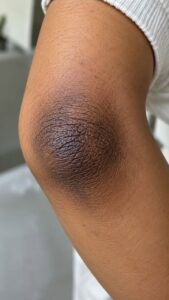 A close-up of a person applying a homemade scrub to their dark elbow with natural ingredients like lemon and baking soda