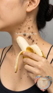 Close up of a banana peel being applied to a small wart on a finger secured with a small piece of medical tape