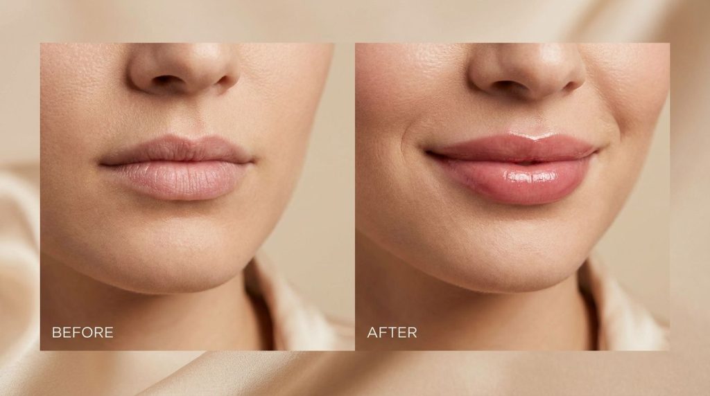 A woman s lips clearly showing a before and after comparison with the after lips appearing noticeably fuller smoother an